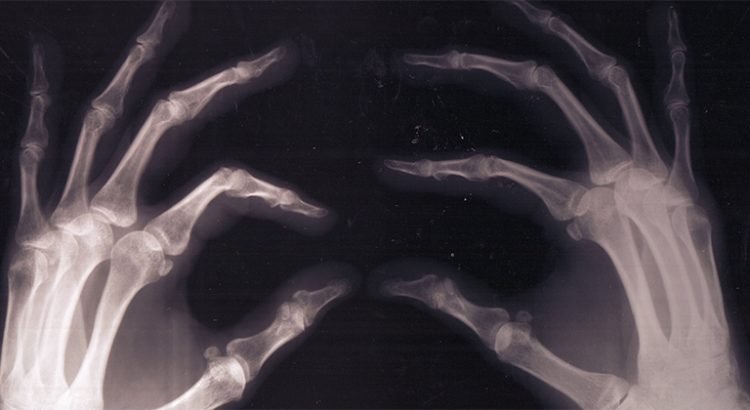 Cannabis et fracture des os