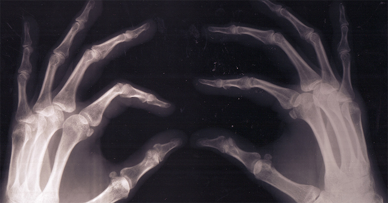 Cannabis et fracture des os