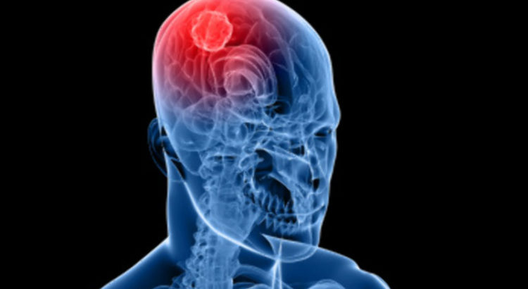 Les Anglais recherchent un lien entre le CBD et la réduction des tumeurs aux cerveau chez l'enfant