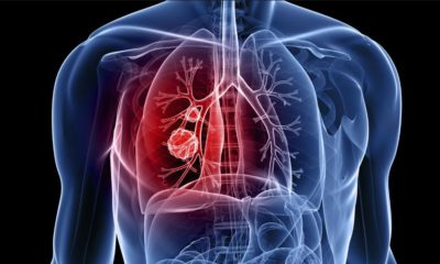 Cancer du poumon et CBD:THC