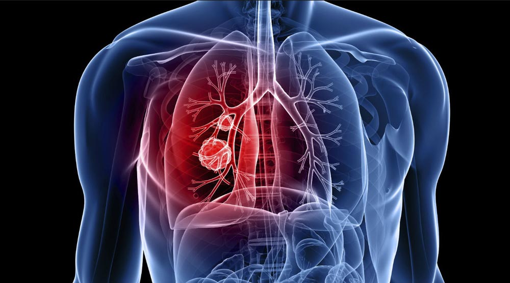 Cancer du poumon et CBD:THC