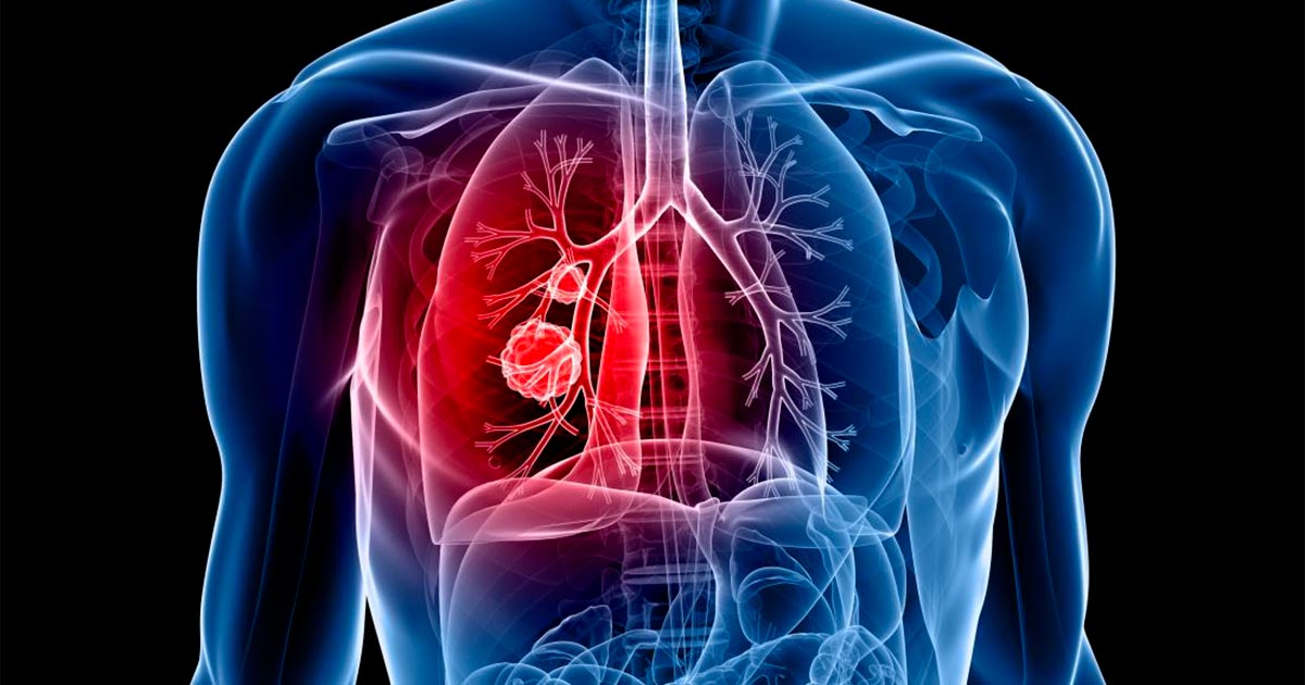 Cancer du poumon et CBD