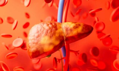 Stéatose hépatique et cannabinoïdes